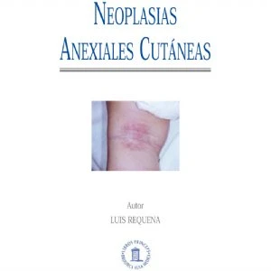 Neoplasias Anexiales Cutáneas